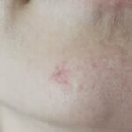 0-after-mole-removal.jpg