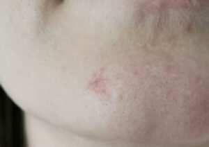 Can Mole Removal Treatments Leave Scars?