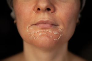 Can Chemical Peels Damage Your Skin?