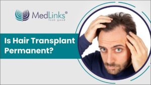 Is Hair Transplant Permanent? They Last Forever? | Hair Transplant in Delhi