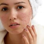 Acne-Scar-Treatment-in-Dubai.jpg