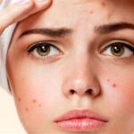Acne-Treatment-in-Dubai2.jpg