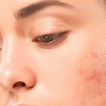 Acne-Treatment-in-Dubai45.webp