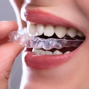 Top-Rated Aligners Clinics in Islamabad – Expert Orthodontists