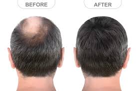 Are Hair Loss Treatments in Dubai Painful or Comfortable?