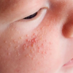 Are-Professional-Milia-Treatments-Safe-for-Kids.png