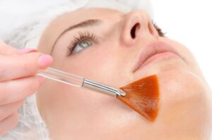 What Exactly Is a Mandelic Peel and How Does It Improve the Skin?