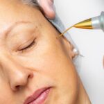Can-Plasma-Pen-Treat-Under-Eye-Wrinkles.jpg