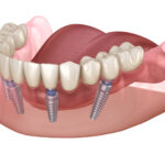 Dental-implants-in-Riyadh-15.jpg