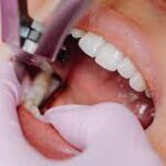Expert-care-for-wisdom-tooth-removal.jpg
