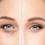 Eyelid-Surgery-in-Riyadh-5.webp