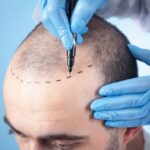 FUE-Hair-Transplant-in-Islamabad-Pakistan-GAC-See-Cost-Results.jpg