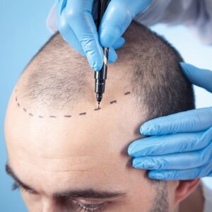 The Evolution of FUE Hair Transplant in Dubai UAE