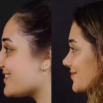 H-Rhinoplasty-8.jpg