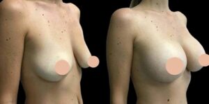 Natural-Looking Results with Advanced Breast Augmentation in Dubai Techniques