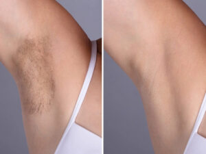 Best Doctors in dubai for Reliable Laser Hair Removal Treatments