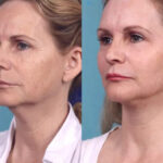 H2-Chemical-Peel.jpg