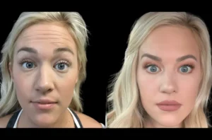 How Safe Are Botox Treatments in Dubai? What You Should Know