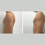 H3-Gynecomastia.jpg