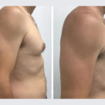 H5-Gynecomastia.jpg