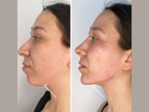 Get Natural Rejuvenation with Endolift from the Best Doctors in Dubai