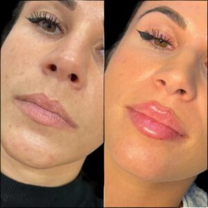 Fillers Treatments in Dubai: A Quick Fix for Wrinkles