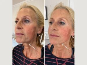 Achieve a Defined Jawline with Endolift: Recommendations from the Best Plastic Surgeon in Dubai
