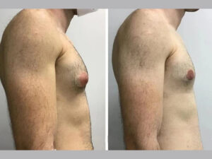 Best Gynecomastia Doctors in Dubai Excellence in Man Boob Surgery