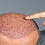 Hair-Grafting-Near-Me-Dubai.jpg