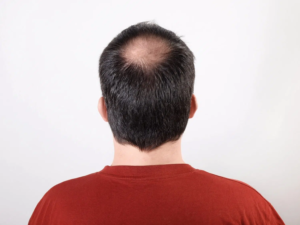 Can Crown Hair Transplant Restore Bald Spots?
