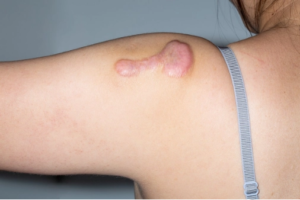 Can Keloid Treatment Help Diminish the Appearance of Old Scars?