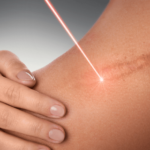 Laser-Scar-Removal-London-UK.png