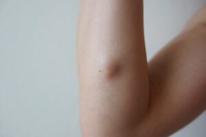 Discover the Latest Lipoma Treatment Innovations in Dubai