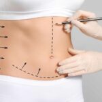 Liposuction-in-Islamabad.jpg