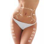 Liposuction-in-Islamabad.png