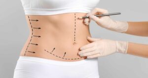 Best Liposuction for Belly Fat in Islamabad