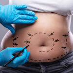 Liposuction-in-Riyadh-23.jpg