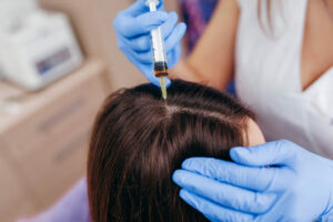 The Ultimate Guide to PRP for Hair Rejuvenation in Islamabad