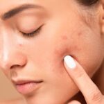 Pimples-Treatment-in-Riyadh-4.jpg