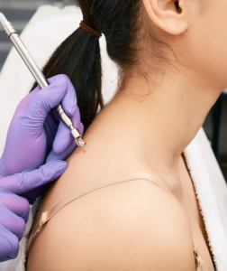 What Steps Are Involved in Skin Tag Removal