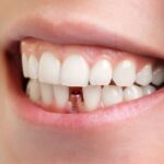 Same-Day-Dental-Implants-in-Dubai-Single-Tooth-Dental-Implant-Cost-1.jpg