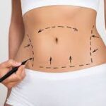 Smooth-contours-with-liposuction.jpg