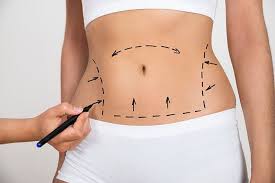 Can Liposuction Surgery Remove Cellulite?