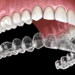 Teeth-Aligners-Perth.jpg
