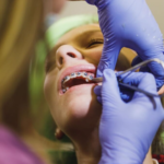 Teeth-Braces-Treatment-in-Vikaspuri.PNG