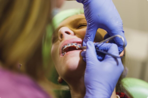 Teeth Braces Treatment in Vikaspuri – Straighten Your Smile with Expert Care