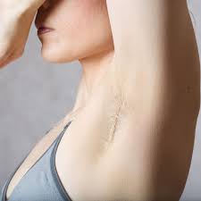 How to Recover From Armpit Pigmentation After Peeling?