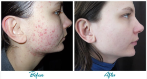 Which non-invasive treatments work for mild acne scars in Dubai?