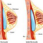 breast.jpeg