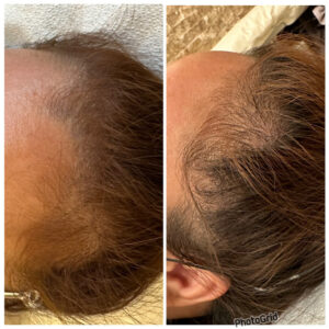 Exosome Hair Treatment Islamabad – Professional Hair Loss Clinics